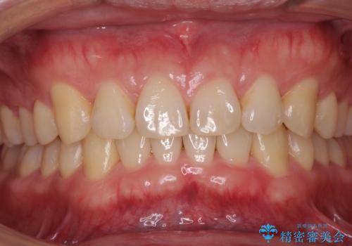 下の歯のがたつきが気になる。 インビザラン&ワイヤー部分矯正併用の治療後