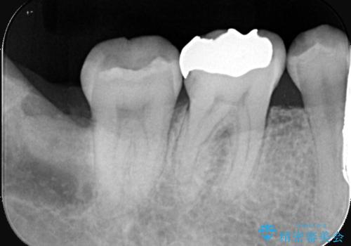 歯の根元の虫歯も精密治療で解決の治療前