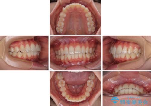 深い咬み合わせによる隙間 インビザライン矯正でコンプレックスを改善の治療中