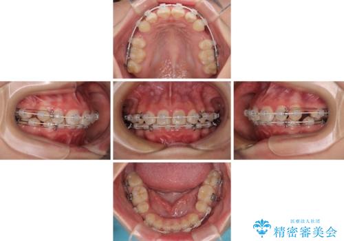 飛び出した口元を改善したい ワイヤー装置による抜歯矯正治療の治療中