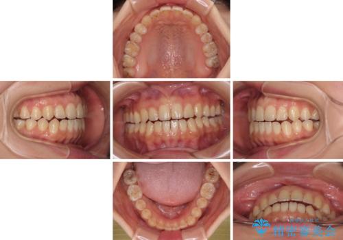 前歯のオープンバイト インビザラインで咬み合わせを改善の治療中
