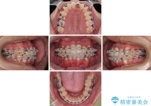 気になる前歯のデコボコと八重歯 ワイヤー矯正ですっきりとの治療中