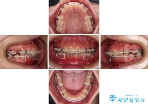骨格的な出っ歯を抜歯矯正で改善 横顔の印象が劇的に変化の治療中