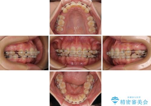 全顎的なデコボコと口元の突出感 ワイヤー装置での抜歯矯正で整った口元にの治療中