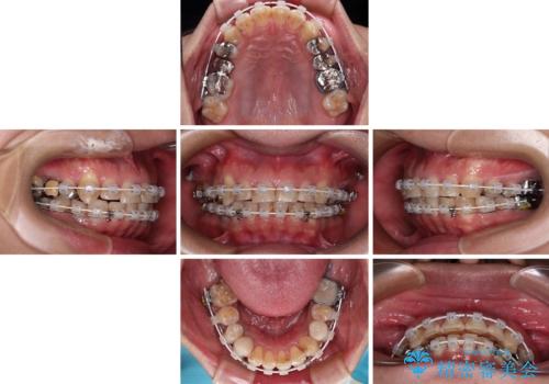 銀歯を白くしたい 一緒に矯正治療も行ない美しい口腔内にの治療中
