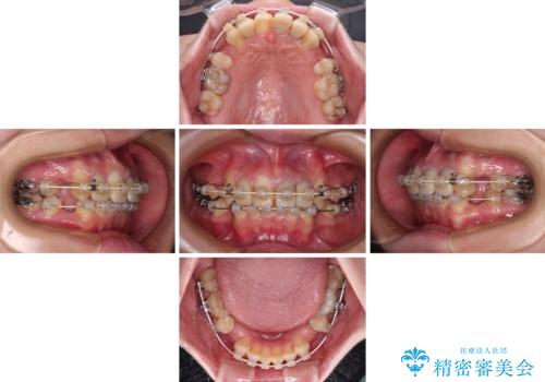 気になっていたむし歯と前歯のデコボコ 矯正治療とむし歯治療の総合歯科治療の治療中