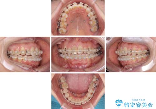骨格的なズレを歯列矯正でカバー ワイヤー装置での非抜歯矯正の治療中