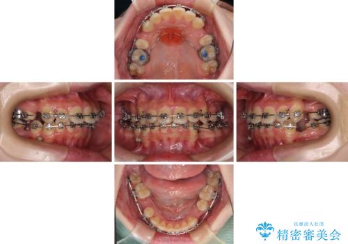 気になる八重歯 ワイヤー装置での抜歯矯正の治療中