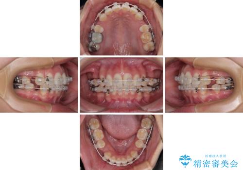 唇を閉じて眠れない ワイヤー装置での抜歯矯正で口元をスッキリとの治療中