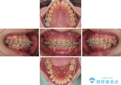デコボコと乳歯の欠損 ワイヤー矯正とインプラント補綴治療の治療中
