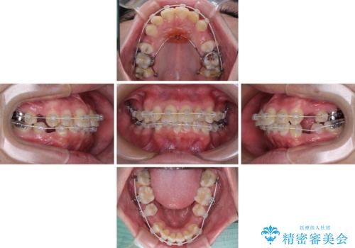 【モニター】出っ歯と奥歯の咬み合わせを改善 補助装置を用いたワイヤー抜歯矯正の治療中