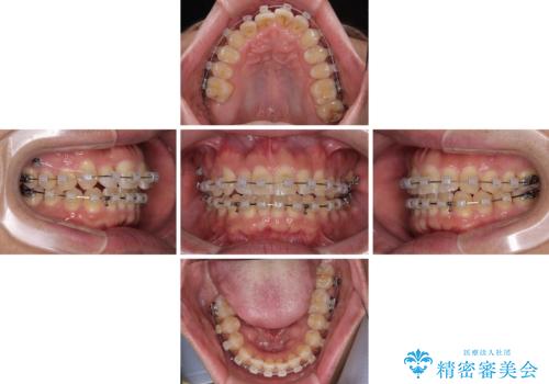 インビザラインは煩わしい ワイヤー矯正で短期間矯正治療の治療中