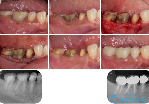 新幹線通院 地元で断られた奥歯のむし歯治療の治療中