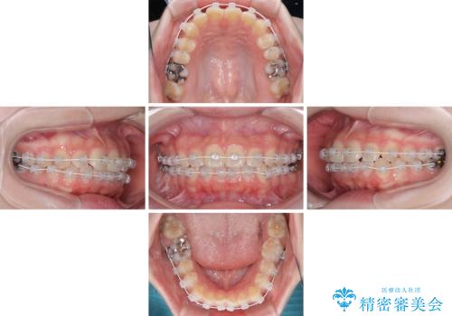 気になる前歯を矯正 短期間のワイヤー矯正治療の治療中