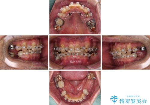 奥歯の欠損と前歯のデコボコを治したい インプラントと矯正治療の総合歯科治療の治療中