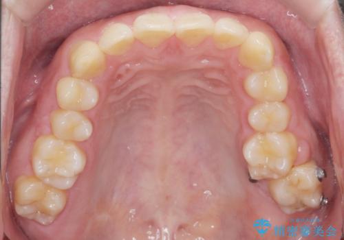 下の歯のがたつきが気になる。 インビザラン&ワイヤー部分矯正併用の治療中