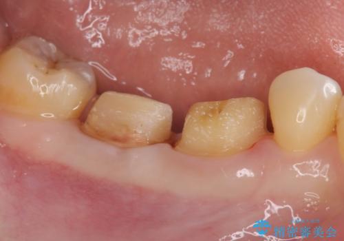 歯周ポケットの除去を併用したセラミック治療の治療中