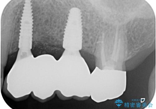 入れ歯では食事を楽しめない。インプラントによる咬合機能回復の治療後