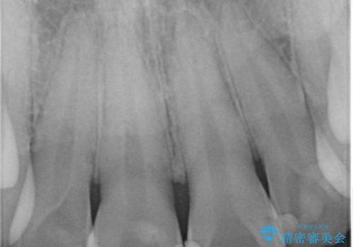 前歯綺麗にしたい。の治療前
