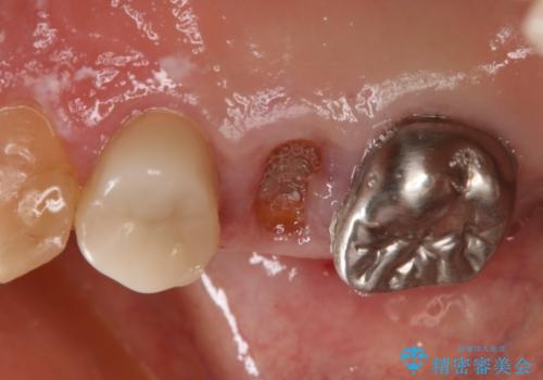 上の奥歯が折れた 抜歯即時埋入インプラントの治療前