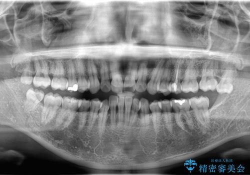 口ボコと歯のデコボコが気になる!|前歯が出ていて口が閉じにくい|審美ワイヤー矯正による口元の改善!の治療前