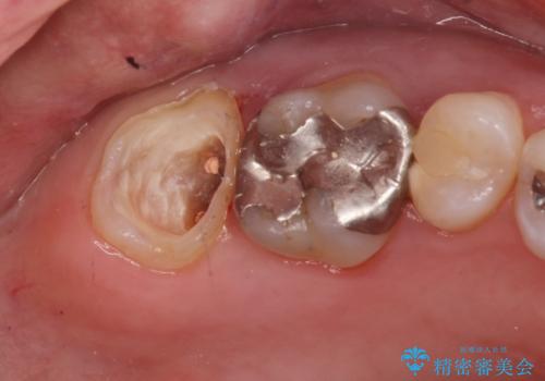 右奥歯治療が必要と言われた。の治療中