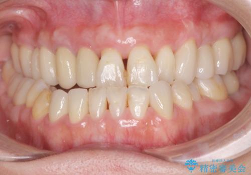 歯周病治療&セラミック治療の症例 治療後