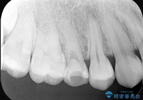 【根管治療】【セラミッククラウン】根っこが細くて治療できないと言われたの治療前