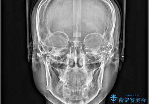 非抜歯矯正で八重歯を改善|短期間8か月で美しい歯並びに|インビザラインライト上顎のみで矯正の治療後