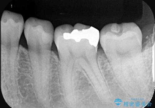 虫歯 〈セラミックインレー〉の治療前