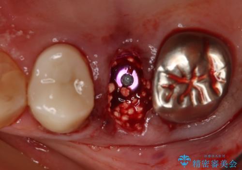 上の奥歯が折れた 抜歯即時埋入インプラントの治療中