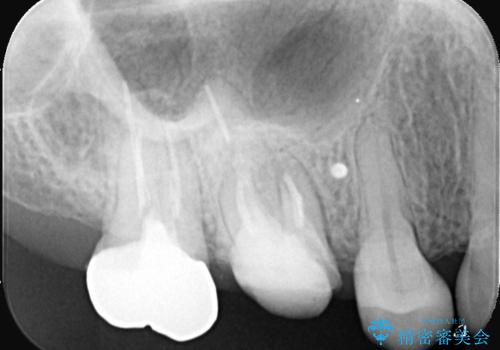歯のひび割れによる奥歯の痛みも即日解決の症例 治療前