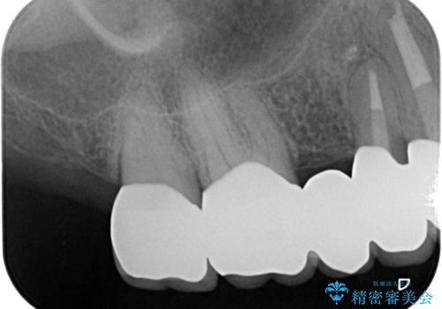 歯周ポケットの除去を併用したセラミック治療の治療後