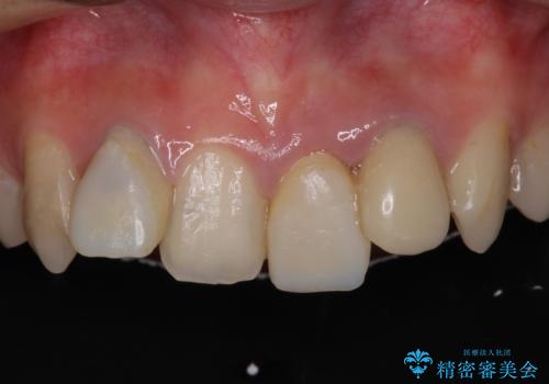 気になっていたむし歯と前歯のデコボコ 矯正治療とむし歯治療の総合歯科治療の治療前