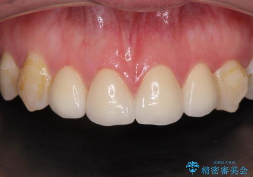 前歯綺麗にしたい。の症例 治療後
