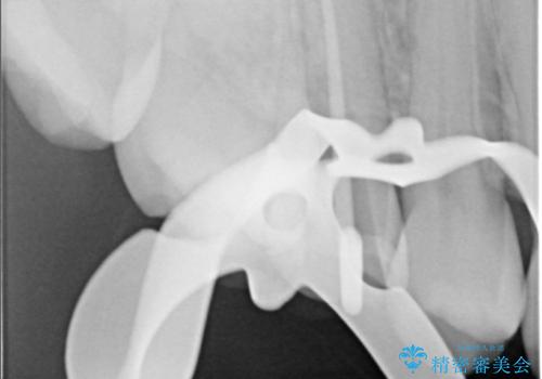【根管治療】【セラミッククラウン】根っこが細くて治療できないと言われたの治療中
