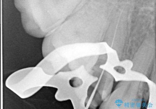 【根管治療】【セラミッククラウン】根っこが細くて治療できないと言われたの治療中