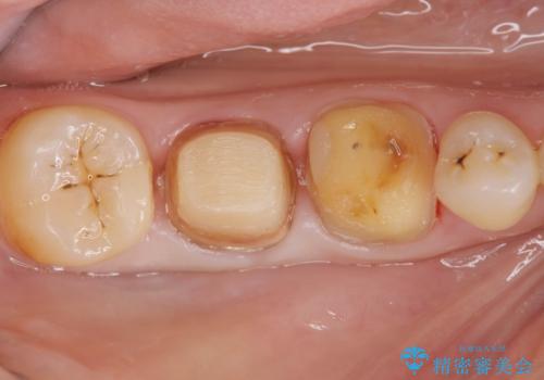 歯周ポケットの除去を併用したセラミック治療の治療中