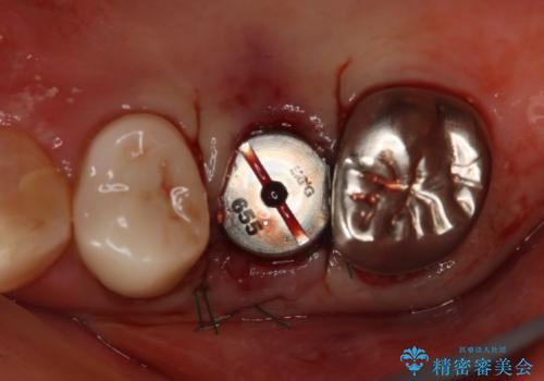 上の奥歯が折れた 抜歯即時埋入インプラントの治療中