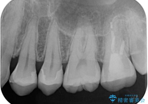 レジンが劣化してきた オールセラミッククラウンの治療前