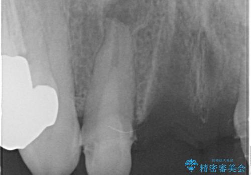 [ 前歯セラミックブリッジ治療 ]  転んで抜けた前歯 、見た目をきれいにしたいの治療中