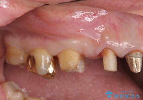 歯周ポケットの除去を併用したセラミック治療の治療中