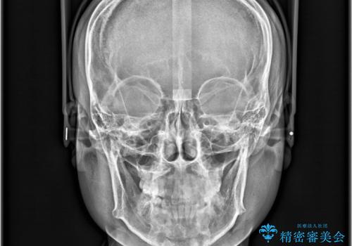 非抜歯矯正で八重歯を改善|短期間8か月で美しい歯並びに|インビザラインライト上顎のみで矯正の治療前