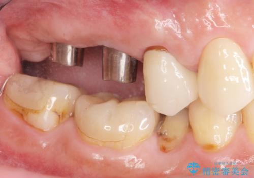 欠損した奥歯 インプラント補綴の治療中
