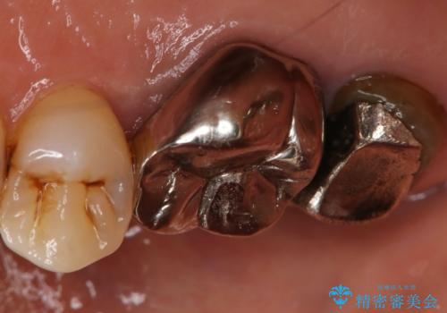 奥歯が取れた フルジルコニアクラウンの治療前