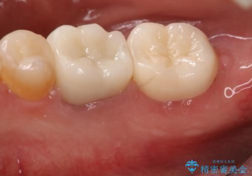 奥歯が痛む オールセラミッククラウンの治療後