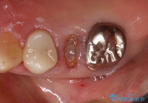 上の奥歯が折れた 抜歯即時埋入インプラントの治療前