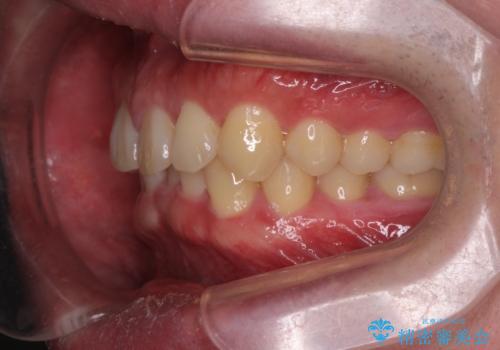 下の歯のがたつきが気になる。 インビザラン&ワイヤー部分矯正併用の治療前