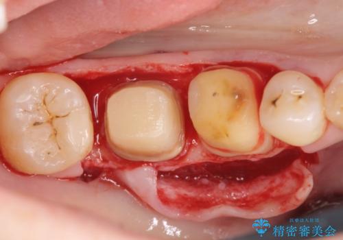 歯周ポケットの除去を併用したセラミック治療の治療中