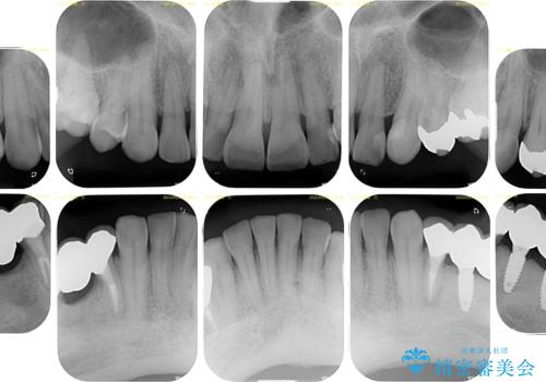 奥歯の欠損と前歯のデコボコを治したい インプラントと矯正治療の総合歯科治療の治療後